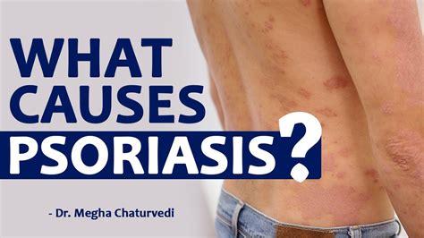 What Causes Psoriasis By Dr Megha Chaturvedi Youtube