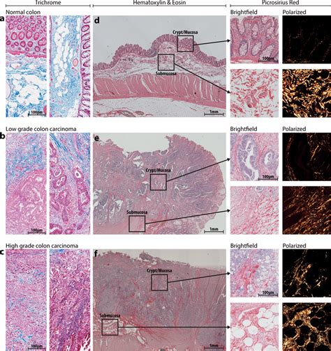 Clinical Colorectal Cancer Sample Morphology Collagen Structure And