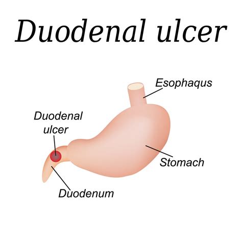 Duodenal Ulcer Overview Causes Symptoms Treatment Illness Com