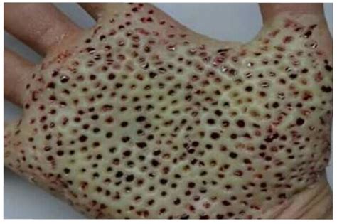 What Is Trypophobia Symptoms And Diagnosis Infographi