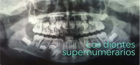 Dientes Supernumerarios Dental Dosdoce