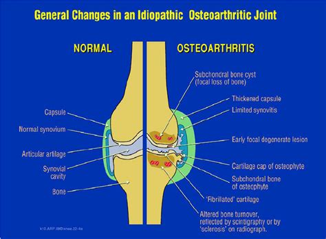Osteoarthritis Is Manifested By Changes In All The Tissues In The