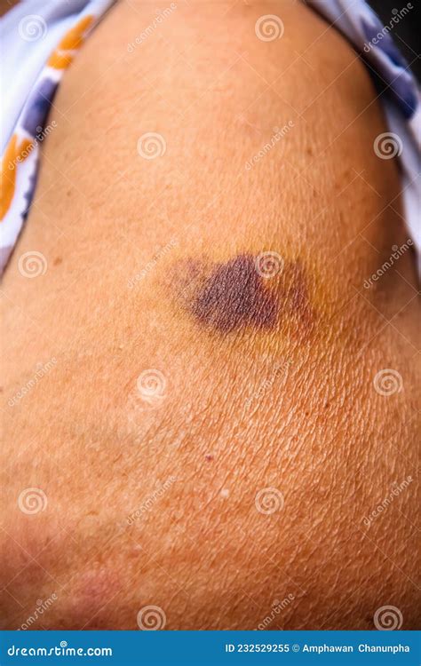 Close Up Bruise Skin Texture Of Old Asian Woman Left Arm After