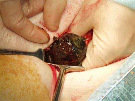 Sigmoid Gallstone Ileus A Rare Cause Of Large Bowel Obstruction Bmj