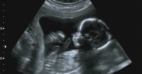 Fda Issues Ultrasound Warning A Must Read For Parents To Be Nw
