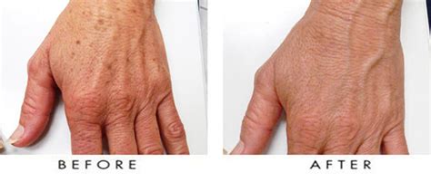 Hand Rejuvenation Nj Laser Resurfacing 07450 Third Space Medical