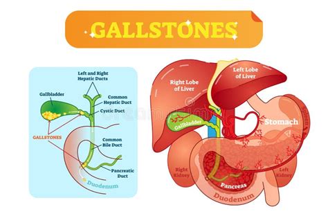 Gallstones Anatomical Cross Section Vector Illustration Diagram With