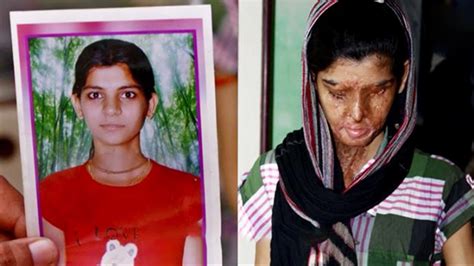 These Horrific Survivor Stories Of Acid Attack Victims Will Show You What Courage Really Means
