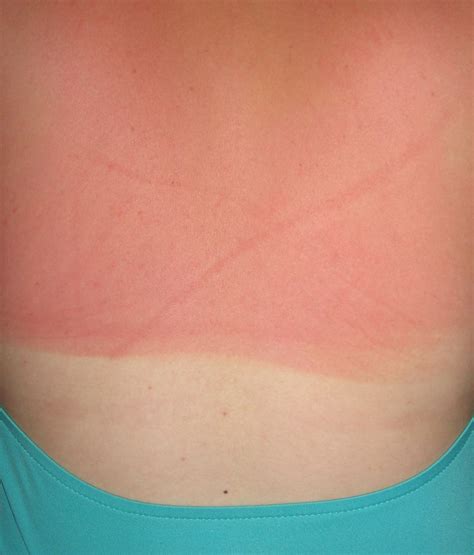 1st 2nd 3rd degree burn pictures. Burn Pictures: A Close Look at First, Second, and Third Degree