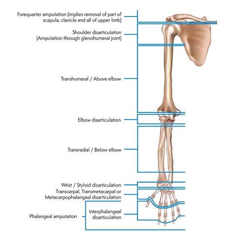 What Are My Prosthetic Options Based On My Amputation Level