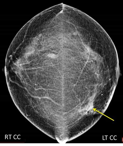 Ductal Carcinoma In Situ – Radiology Cases