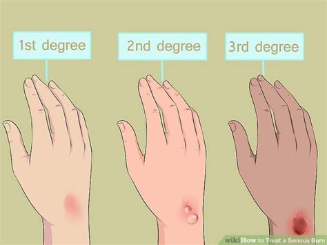 3 Ways To Treat A Serious Burn Wikihow