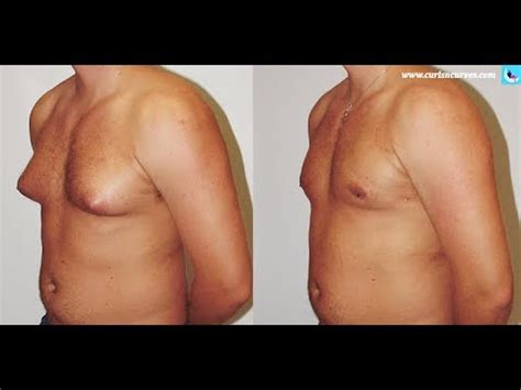 How can i get rid of gynecomastia naturally? Gynecomastia causes, Symptoms and Treatment - Curls ...