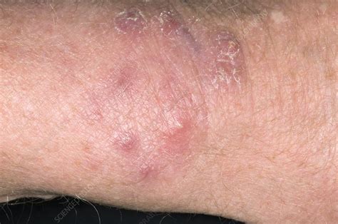 Ringworm Skin Infection Stock Image M2700365 Science Photo Library