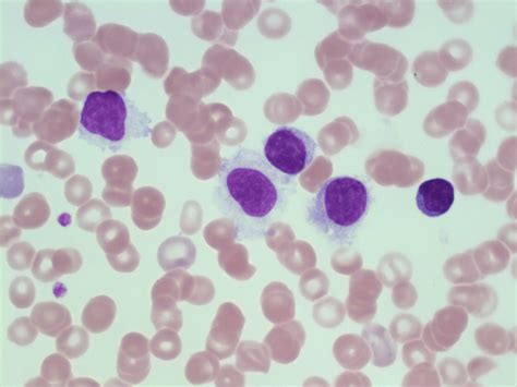 Hairy Cell Leukemia Hcl A Laboratory Guide To Clinical Hematology