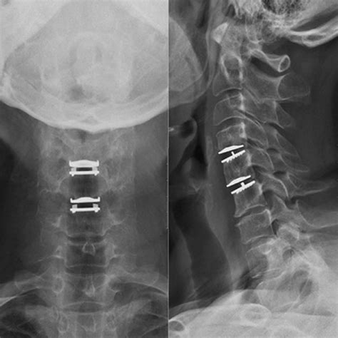 Postoperative 10 Year Follow Up Cervical Antero Posterior Lateral