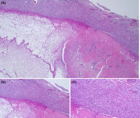 Pancreatic Pseudocyst Histology