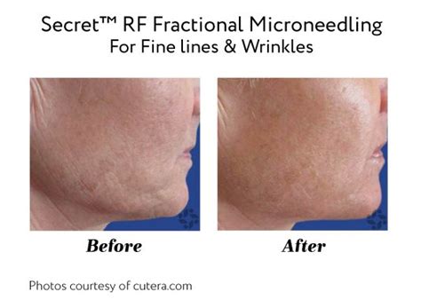 Secret™ Rf Microneedling Cutera Skin Renewal