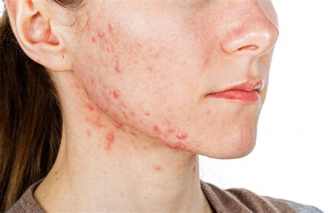 How Do You Effectively Manage Skin Infections