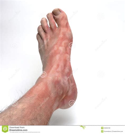 Itchy Foot Royalty Free Stock Images Image 32252129