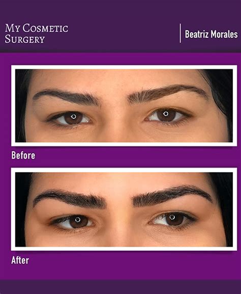 It's caring for the tattooed area afterward. Eyebrows Microblading and Lashes - My Cosmetic Surgery Miami