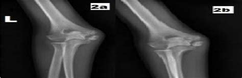 Figure 6 From A Rare Case Of Osteochondroma Proximal Ulna With Cubitus