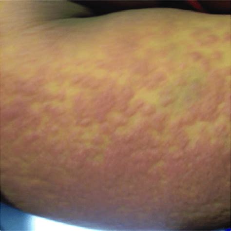 Maculopapular Rash On Right Forearm The Rash Was Diffuse And