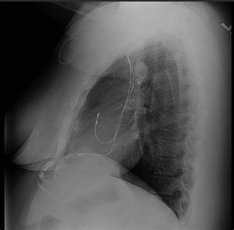 Preoperative Chest X Ray Lateral View Shows The Paratracheal Mass