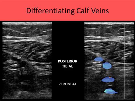 Venous Anatomy Upper Extremity