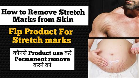 Flp Products For Stretch Marks How To Remove Stretch Marks Remove