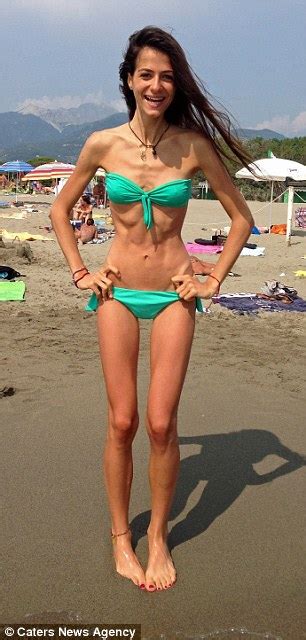 Anorexic Whose Weight Plummeted To Seven Stone Reveals How Instagram