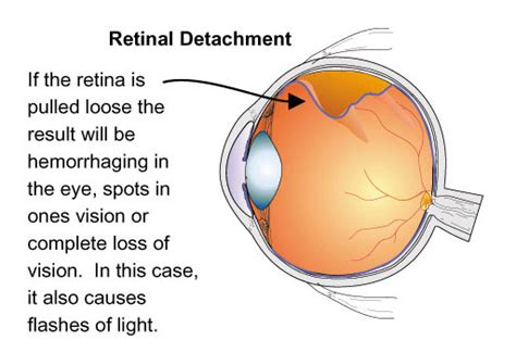 Retinal Detachment The Signs Symptoms And Solutions Ocular Prosthetics Inc