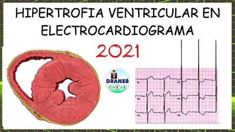 Hipertrofia Ventricular En El Electrocardiograma Youtube