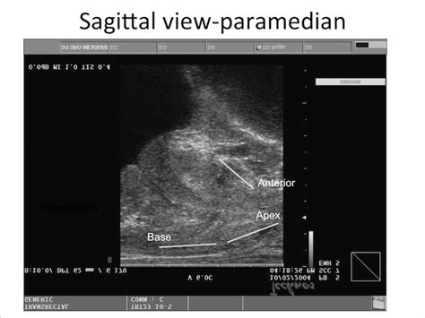 Prostate Sagittal View