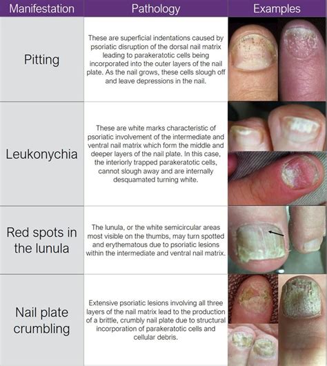 Albums 99 Wallpaper 10 Nail Diseases And Disorders With Pictures