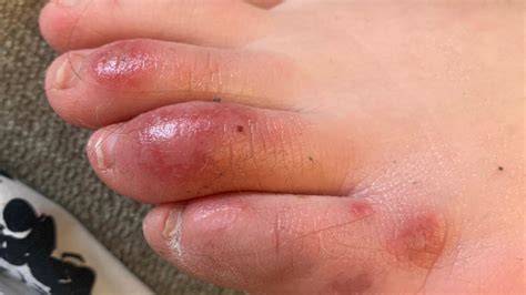 Covid Toes Other Rashes Latest Possible Rare Virus Signs Ap News