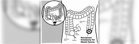 About Colostomy Reversal General Center