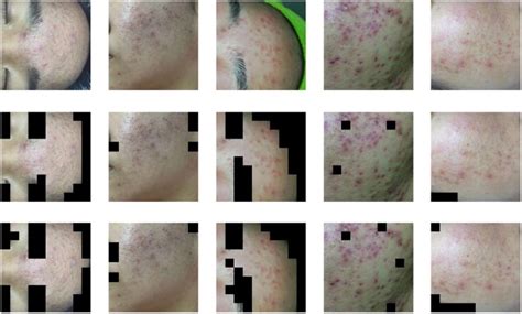 An Automatic Diagnosis Method Of Facial Acne Vulgaris Based On
