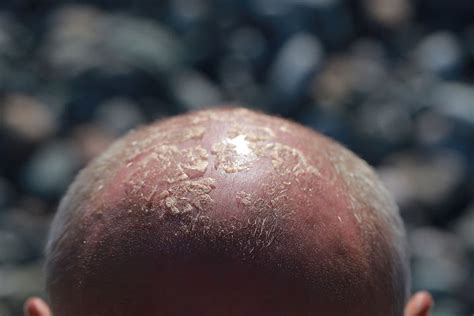 How To Treat A Sunburned Scalp 5 Top Remedies Plus Prevention Tips