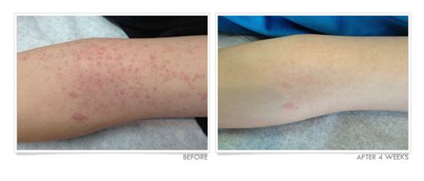 Eczema On Arms Before And After Truelipids