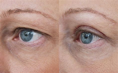 Affordable Places For Extensive Blepharoplastyhow To Make It