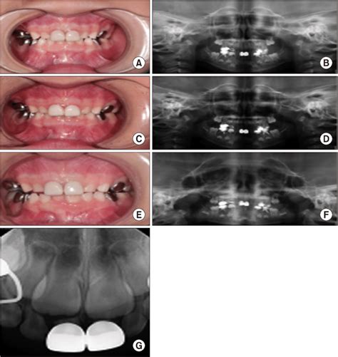 Clinical Photographs And Periapical Radiographs Of Case 2 A B