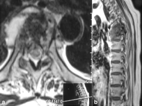 In Potts Spine The Posterior Lesion Is Associated With Anterior