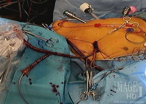 Ismics Direct Aortic Cannulation For Robotic Totally Endoscopic