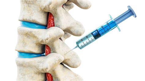 Types Of Spinal Injections New Jersey Comprehensive Spine Care