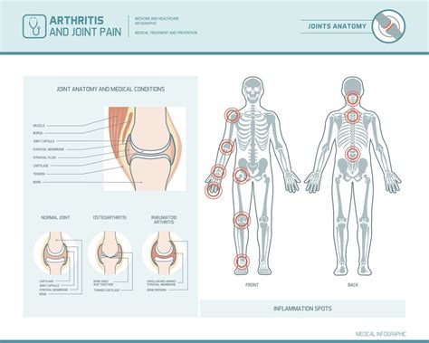 Arthritis Awareness Month Different Types Of Arthritis To Know Cpmc