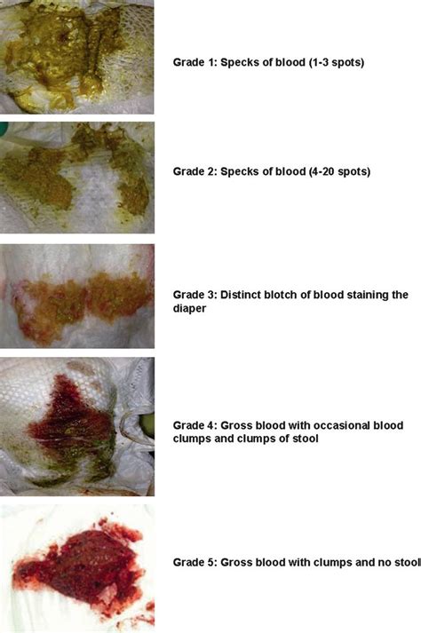 Blood In Stool Pictures