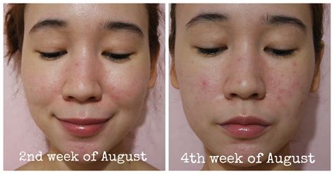 My Isotretinoin Journey Acnotinaccutane 6 Months Skin Update