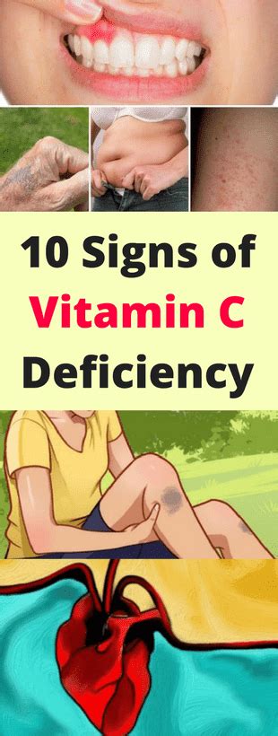 Akeel 73 Here 10 Signs Of Vitamin C Deficiency