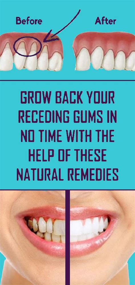 Natural Remedies That Really Help Receding Gums Oral Health Care